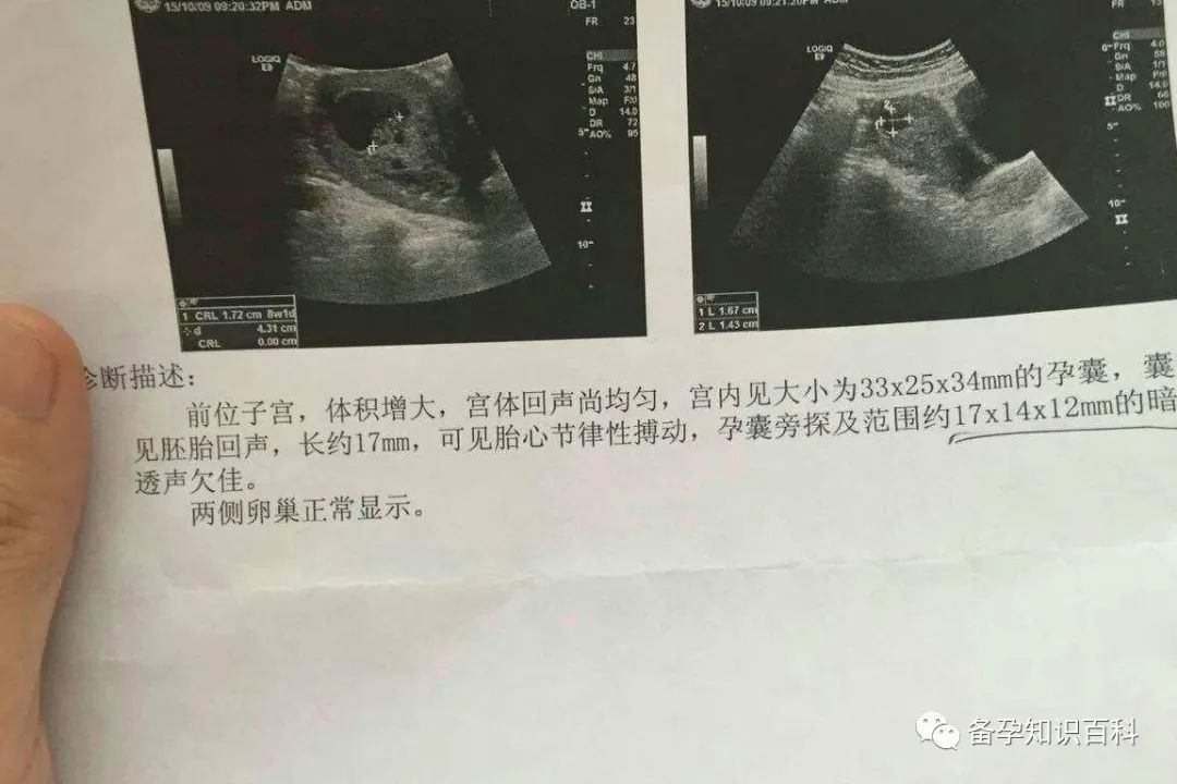 已生宝妈孕囊数据分享：根据孕囊尺寸数据看真的很准！