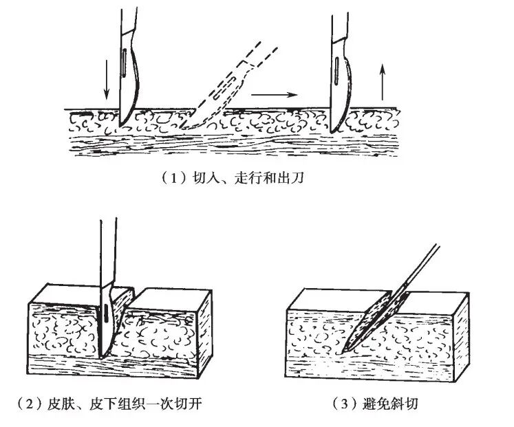 组织钳又叫什么小技巧 ｜｜ 如何把手术切口切得整齐又美观_https://www.jmylbn.com_新闻资讯_第3张