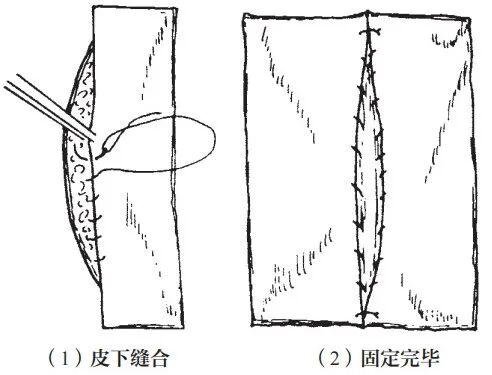 组织钳又叫什么小技巧 ｜｜ 如何把手术切口切得整齐又美观_https://www.jmylbn.com_新闻资讯_第6张