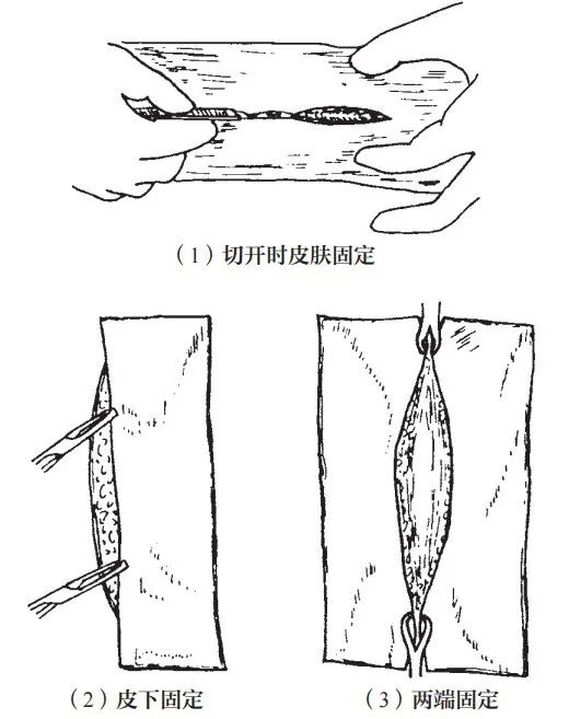 组织钳又叫什么小技巧 ｜｜ 如何把手术切口切得整齐又美观_https://www.jmylbn.com_新闻资讯_第5张