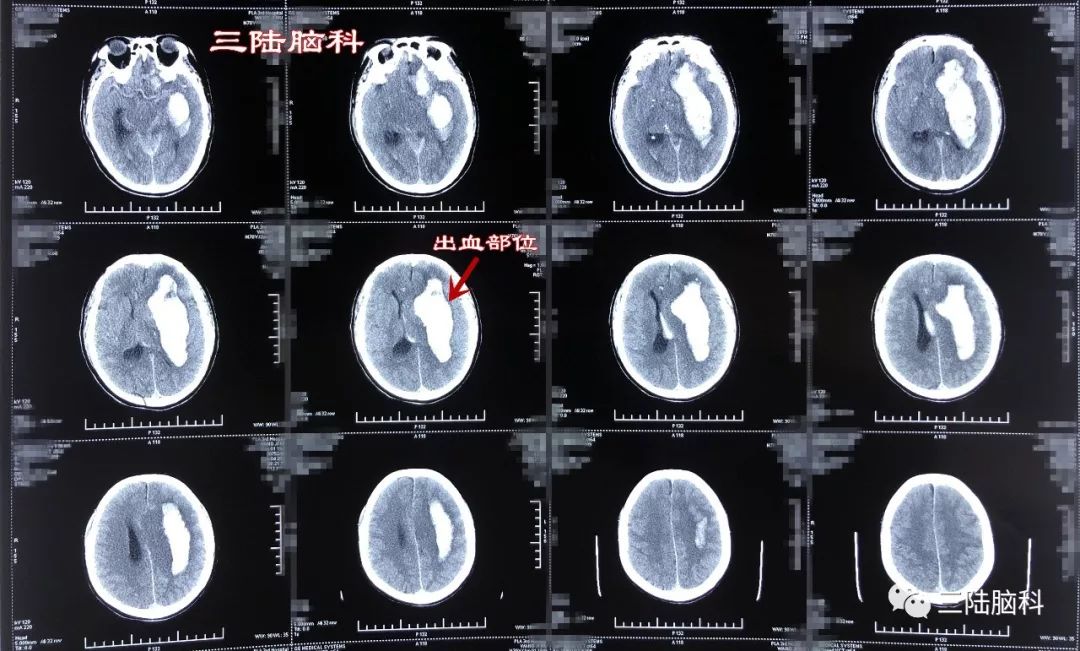 【三陸病例】突發腦出血，急診術下搶生命！ 健康 第3張