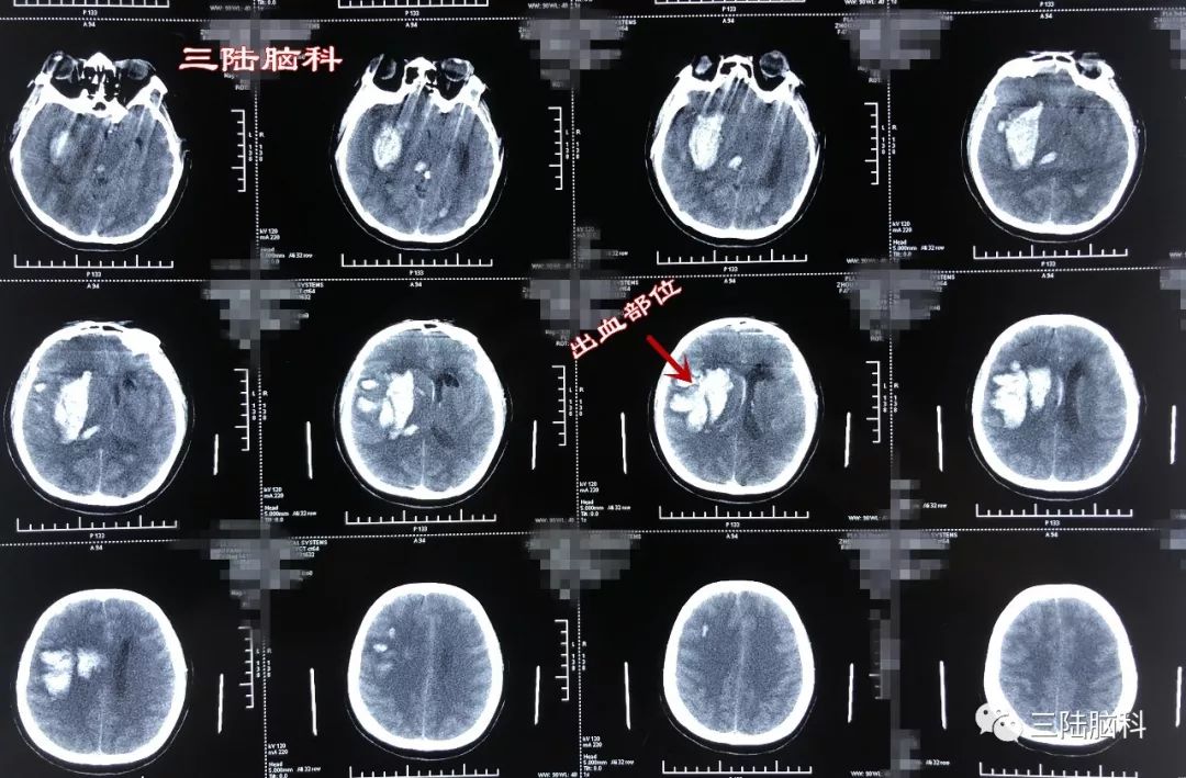 【三陸病例】突發腦出血，急診術下搶生命！ 健康 第5張