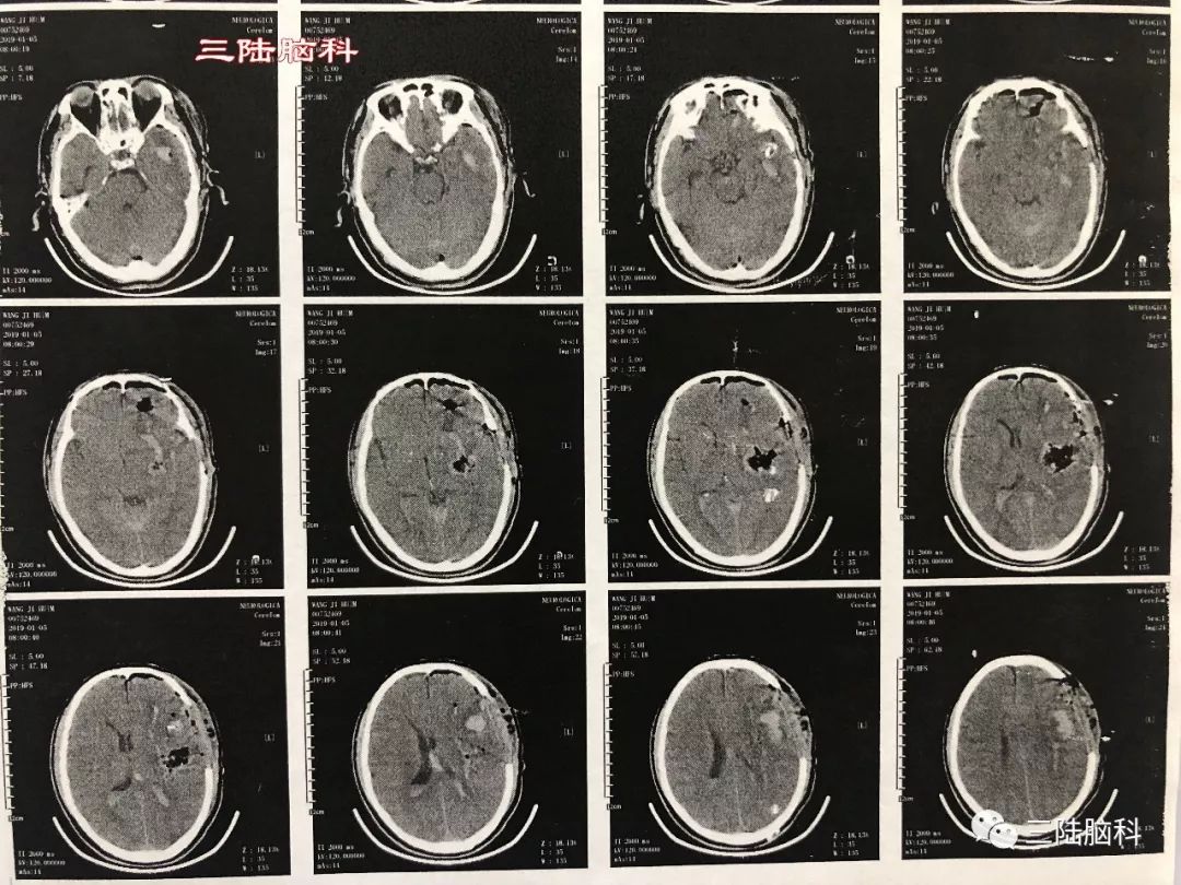 【三陸病例】突發腦出血，急診術下搶生命！ 健康 第4張