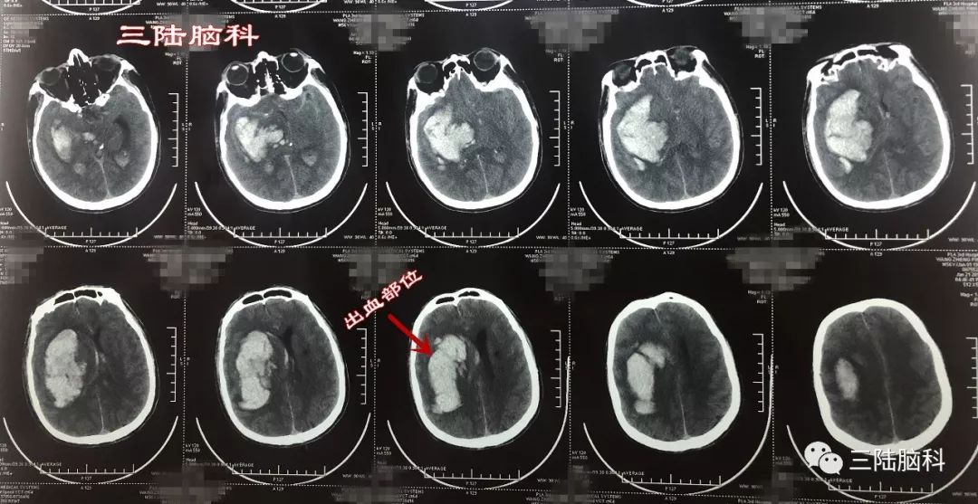 【三陸病例】突發腦出血，急診術下搶生命！ 健康 第7張