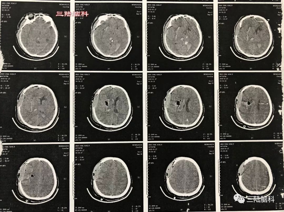 【三陸病例】突發腦出血，急診術下搶生命！ 健康 第6張