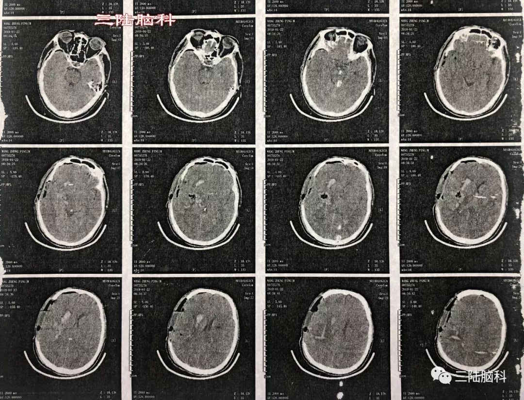 【三陸病例】突發腦出血，急診術下搶生命！ 健康 第8張