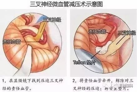 【三陸推薦】你認為牙壞了，其實是三叉神經痛 健康 第7張