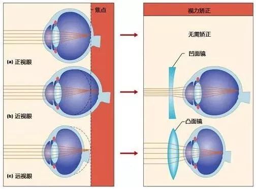 【医学护眼】了解孩子“远视储备”，预防近视.