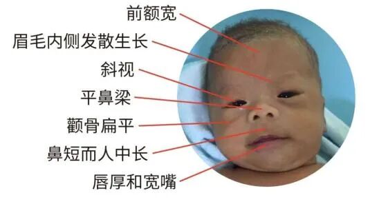 【平安科普】威廉姆斯综合征，一种特殊类型的孤独症