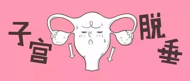 子宫脱垂的症状有哪些？