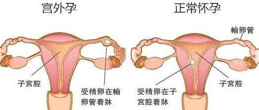 宫外孕会影响以后生育吗？