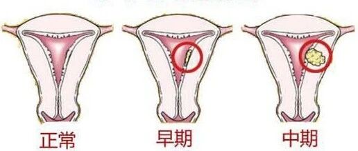 注意！年轻女性也要警惕子宫内膜癌
