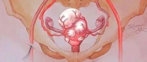 消除子宫肌瘤的3种方法！