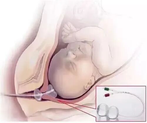 子宫颈扩张球囊是什么小小球囊，助力分娩——子宫颈球囊扩张术了解一下！_https://www.jmylbn.com_新闻资讯_第1张