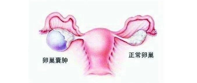 小姑娘为什么会得卵巢囊肿