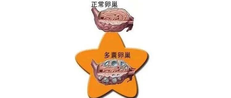 多囊卵巢综合征怎么备孕