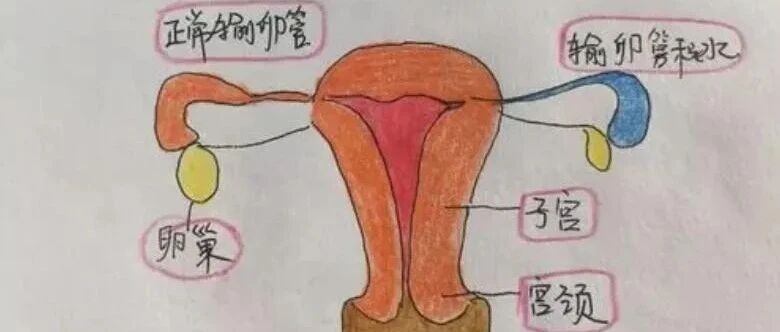 输卵管积水是什么意思