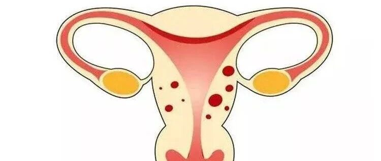 子宫腺肌症会误诊吗