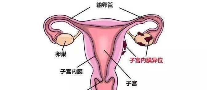 没结婚会得子宫内膜异位症吗