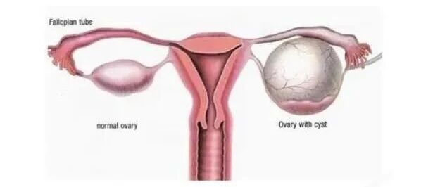 5cm的卵巢囊肿消失了
