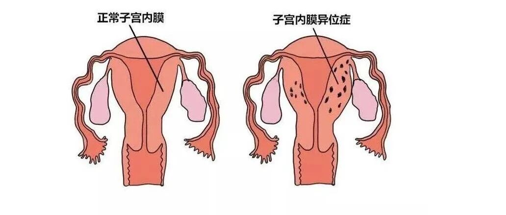 子宫异位症可以彻底治疗好吗