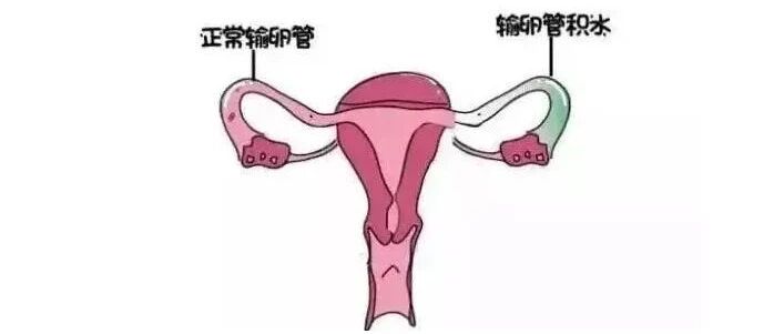 输卵管有积液怎么能消掉