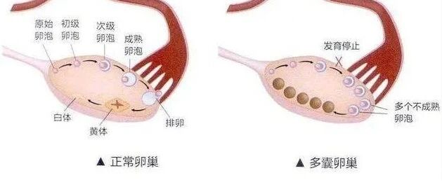 多囊卵巢综合征是什么方式造成的？治疗方式主要有两种