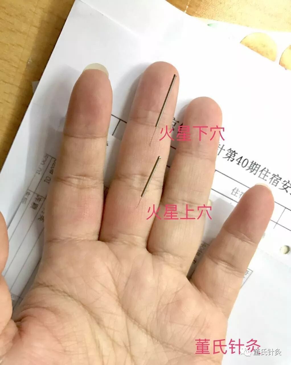 董氏针灸林正泰之微课堂案例分享