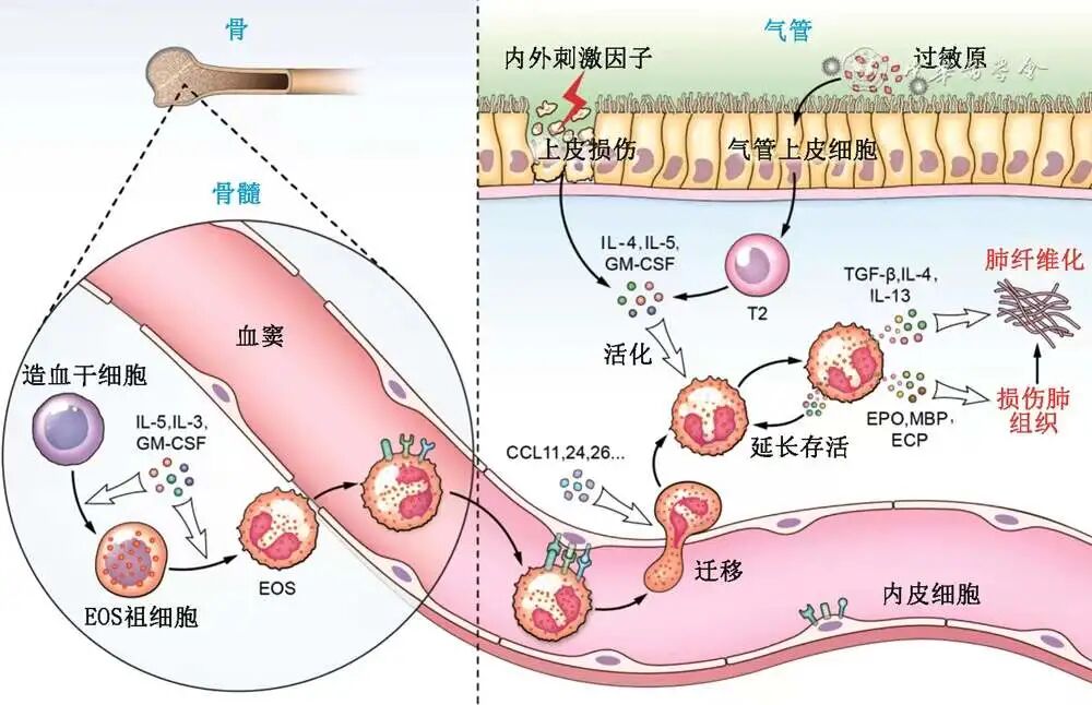 abp在医学是什么意思标准与规范丨嗜酸粒细胞增多相关性肺疾病诊疗中国专家共识_https://www.jmylbn.com_新闻资讯_第6张