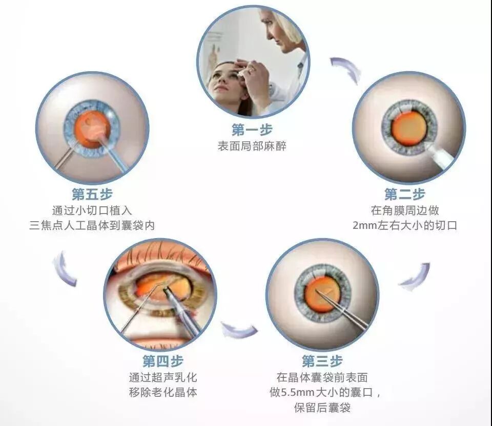 揭秘 | 关于白内障手术的全流程