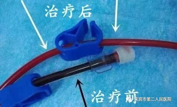 三氧疗法怎么代理来宾市第二人民医院——三氧大自血疗法_https://www.jmylbn.com_新闻资讯_第9张