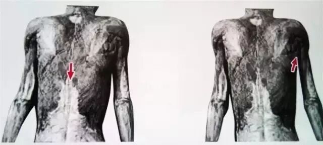 外展枕怎么使用总结的很全的针刀治疗要点，学针刀的人不容错过_https://www.jmylbn.com_新闻资讯_第33张