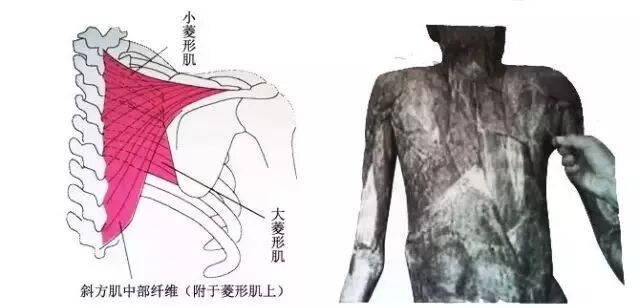 外展枕怎么使用总结的很全的针刀治疗要点，学针刀的人不容错过_https://www.jmylbn.com_新闻资讯_第45张