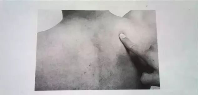 外展枕怎么使用总结的很全的针刀治疗要点，学针刀的人不容错过_https://www.jmylbn.com_新闻资讯_第37张