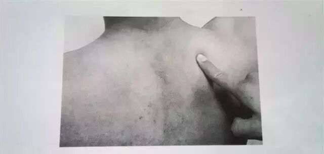 外展枕怎么使用总结的很全的针刀治疗要点，学针刀的人不容错过_https://www.jmylbn.com_新闻资讯_第29张