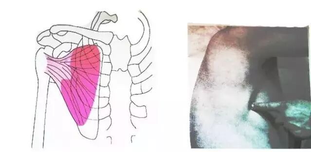 外展枕怎么使用总结的很全的针刀治疗要点，学针刀的人不容错过_https://www.jmylbn.com_新闻资讯_第40张