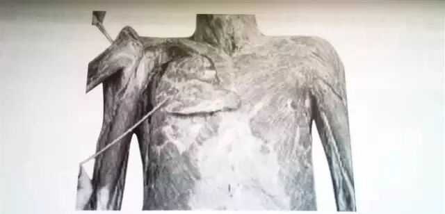 外展枕怎么使用总结的很全的针刀治疗要点，学针刀的人不容错过_https://www.jmylbn.com_新闻资讯_第27张