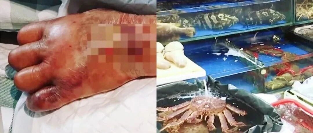 81岁广东大爷感染“夺命菌”！突发高烧，截肢保命！只因碰了这道家常菜