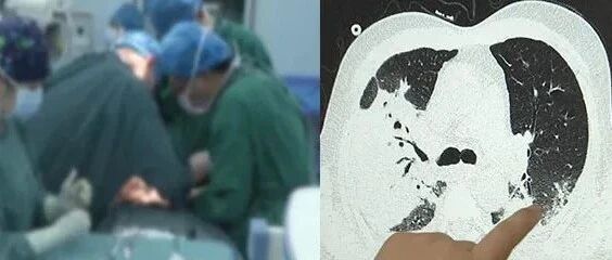 老伯“超低价”种牙，“种”进ICU！肺部更被啃出多个洞！