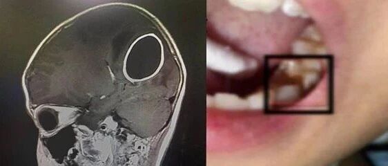 女童突然发烧呕吐，脑内长出大脓包！牙齿这些问题别忽视！