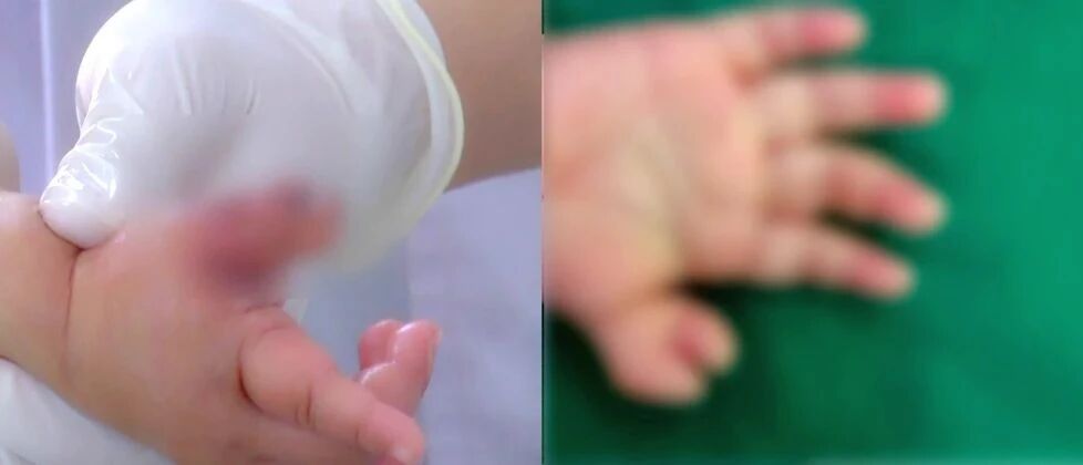 妈妈崩溃！10个月女宝宝竟长出“蟹钳手”！医生：身体有这些症状要警惕