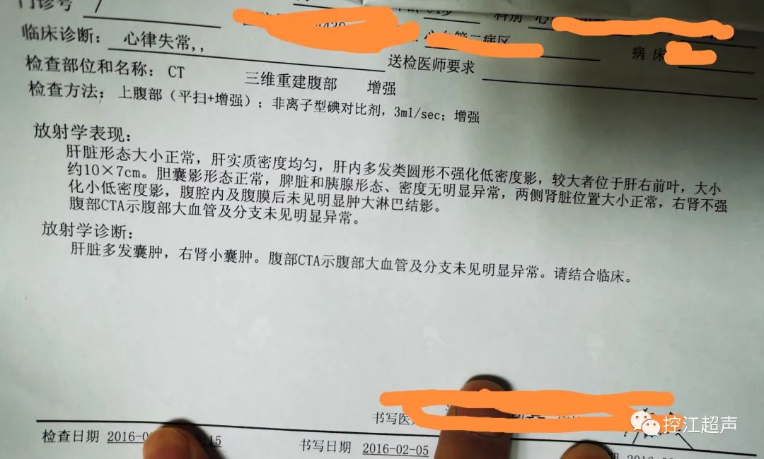 肝囊肿的自然缩小是真的吗