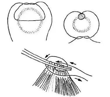 为什么要用皮钉缝合图文并茂丨外科各种缝合方法详解_https://www.jmylbn.com_新闻资讯_第5张