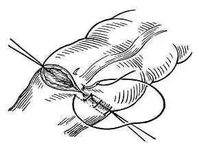 为什么要用皮钉缝合图文并茂丨外科各种缝合方法详解_https://www.jmylbn.com_新闻资讯_第10张