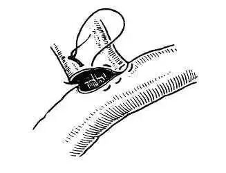 为什么要用皮钉缝合图文并茂丨外科各种缝合方法详解_https://www.jmylbn.com_新闻资讯_第15张