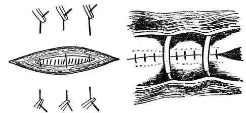 为什么要用皮钉缝合图文并茂丨外科各种缝合方法详解_https://www.jmylbn.com_新闻资讯_第16张