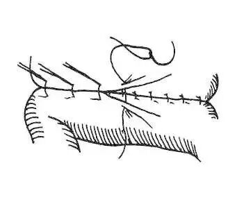 为什么要用皮钉缝合图文并茂丨外科各种缝合方法详解_https://www.jmylbn.com_新闻资讯_第7张