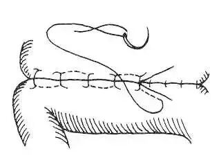 为什么要用皮钉缝合图文并茂丨外科各种缝合方法详解_https://www.jmylbn.com_新闻资讯_第9张