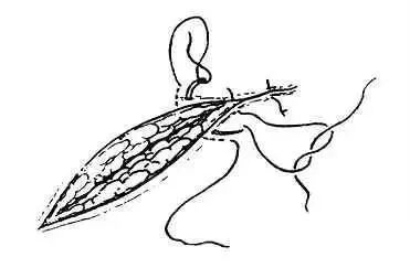 为什么要用皮钉缝合图文并茂丨外科各种缝合方法详解_https://www.jmylbn.com_新闻资讯_第13张