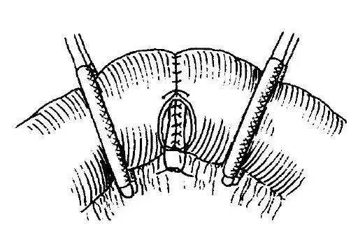 为什么要用皮钉缝合图文并茂丨外科各种缝合方法详解_https://www.jmylbn.com_新闻资讯_第6张